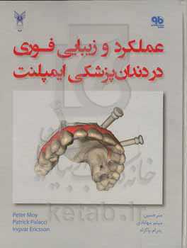 عملکرد و زیبایی فوری در دندان‌پزشکی ایمپلنت