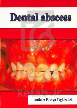Dental abscess