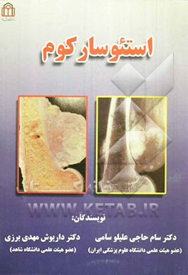 استئوسارکوم