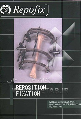 ثابت‌کننده موقعیت استخوان