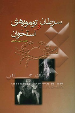 سرطان و تومورهای استخوان