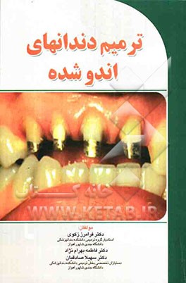 ترمیم دندانهای اندو شده