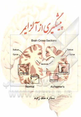 پیشگیری از آلزایمر