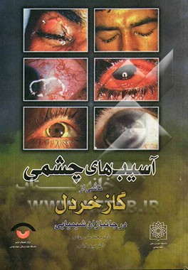 آسیب‌های چشمی ناشی از گاز خردل در جانبازان شیمیایی عمومی