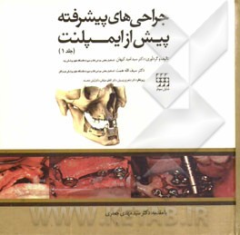 جراحی‌های پیشرفته پیش از ایمپلنت