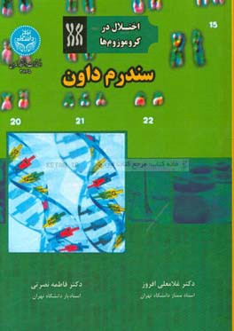 سندروم داون