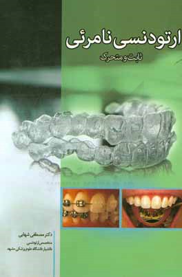 ارتودنسي نامرئي: ثابت و متحرك