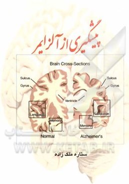 پیشگیری از آلزایمر