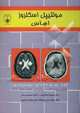 مولتیپل اسکلروز (ام. اس)