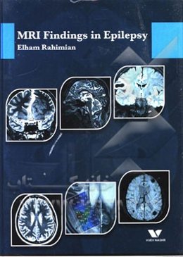 MRI findings in epilepsy