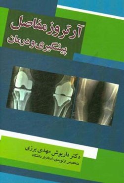 آرتروز مفاصل: پیشگیری و درمان