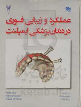 عملکرد و زیبایی فوری در دندان‌پزشکی ایمپلنت