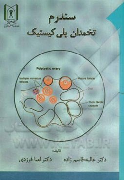 سندرم تخمدان پلی کیستیک