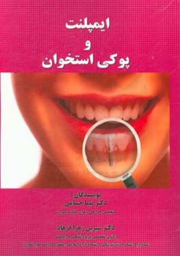 ایمپلنت و پوکی استخوان