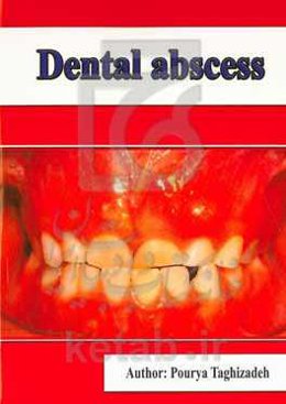 Dental abscess
